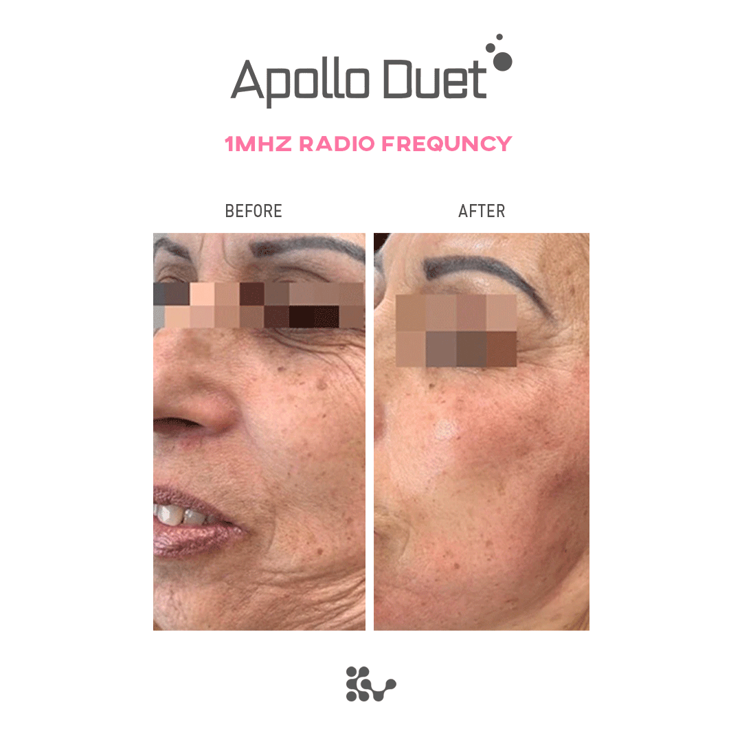 Weero Apollo Duet APD-4000