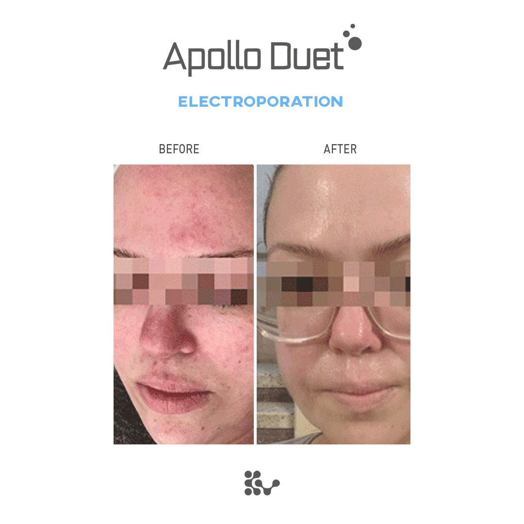 Weero Apollo Duet APD-4000