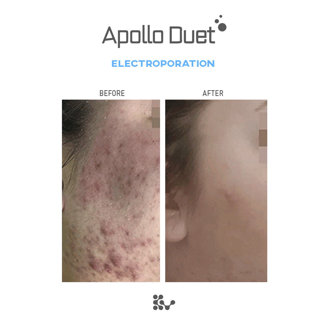 Weero Apollo Duet APD-4000
