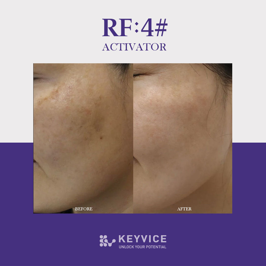 Side-by-side before and after close-up of a woman's cheek showing visibly reduced dark spots, smoother texture, and brighter skin tone after RF:4# Activator treatment by Keyvice