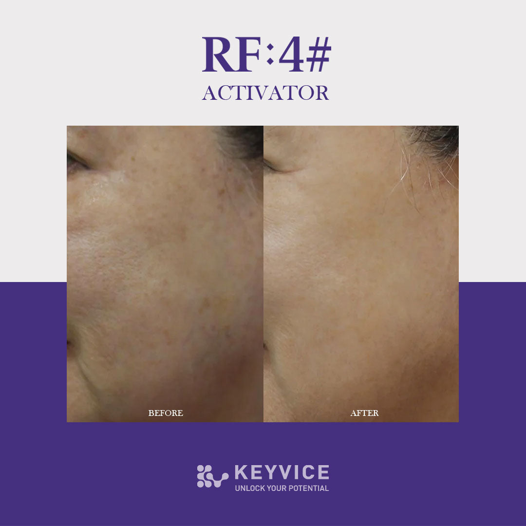 Before and after close-up of cheek skin showing reduced dark spots and improved smoothness after using RF:4# Activator by Keyvice.