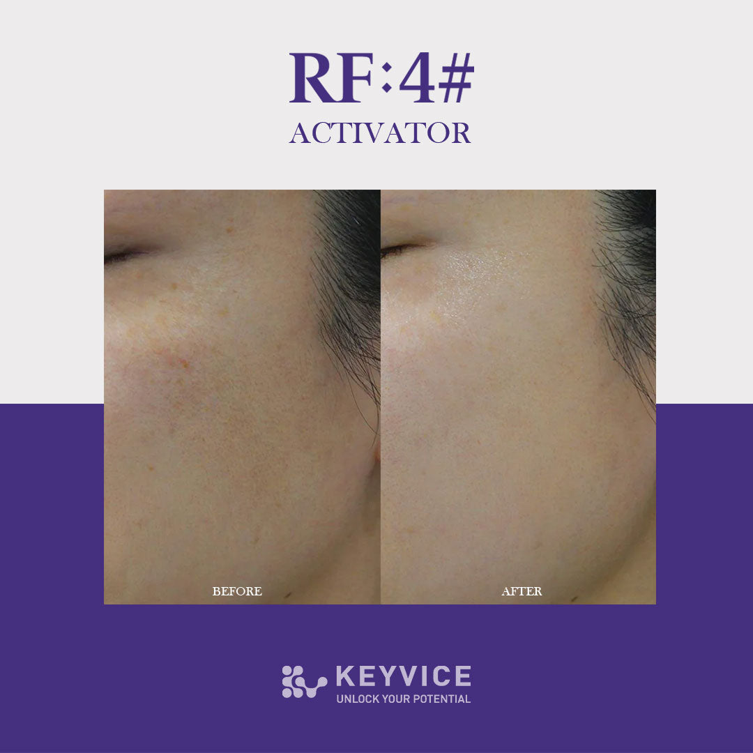 Before and after comparison showing skin improvement on the cheek area after using RF:4# Activator by Keyvice. The 'before' image displays visible uneven skin tone and texture, while the 'after' image shows smoother, brighter, and more even-toned skin.