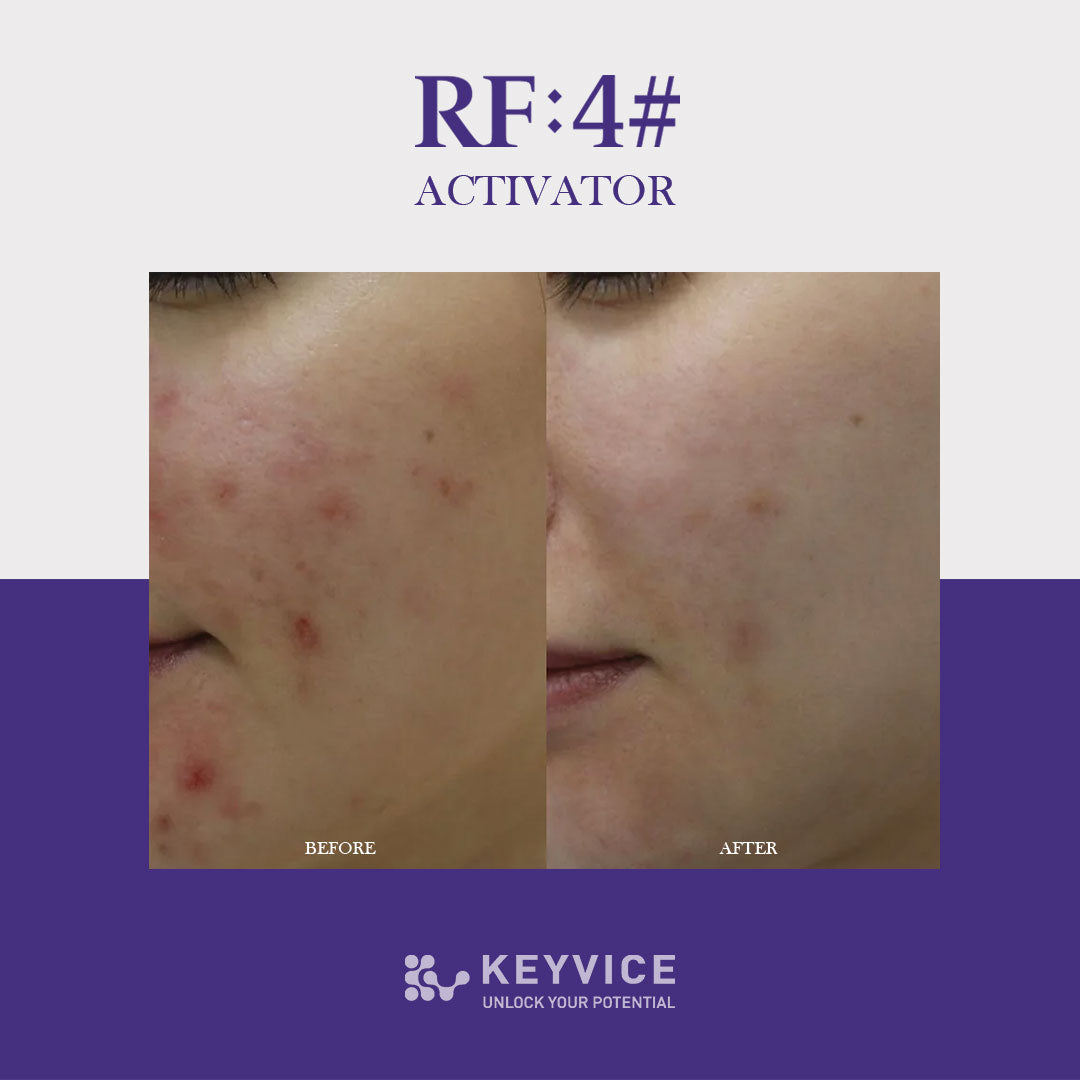Before and after close-up comparison of a woman's cheek showing significant reduction in redness and acne blemishes, with smoother and clearer skin following RF:4# Activator treatment by Keyvice