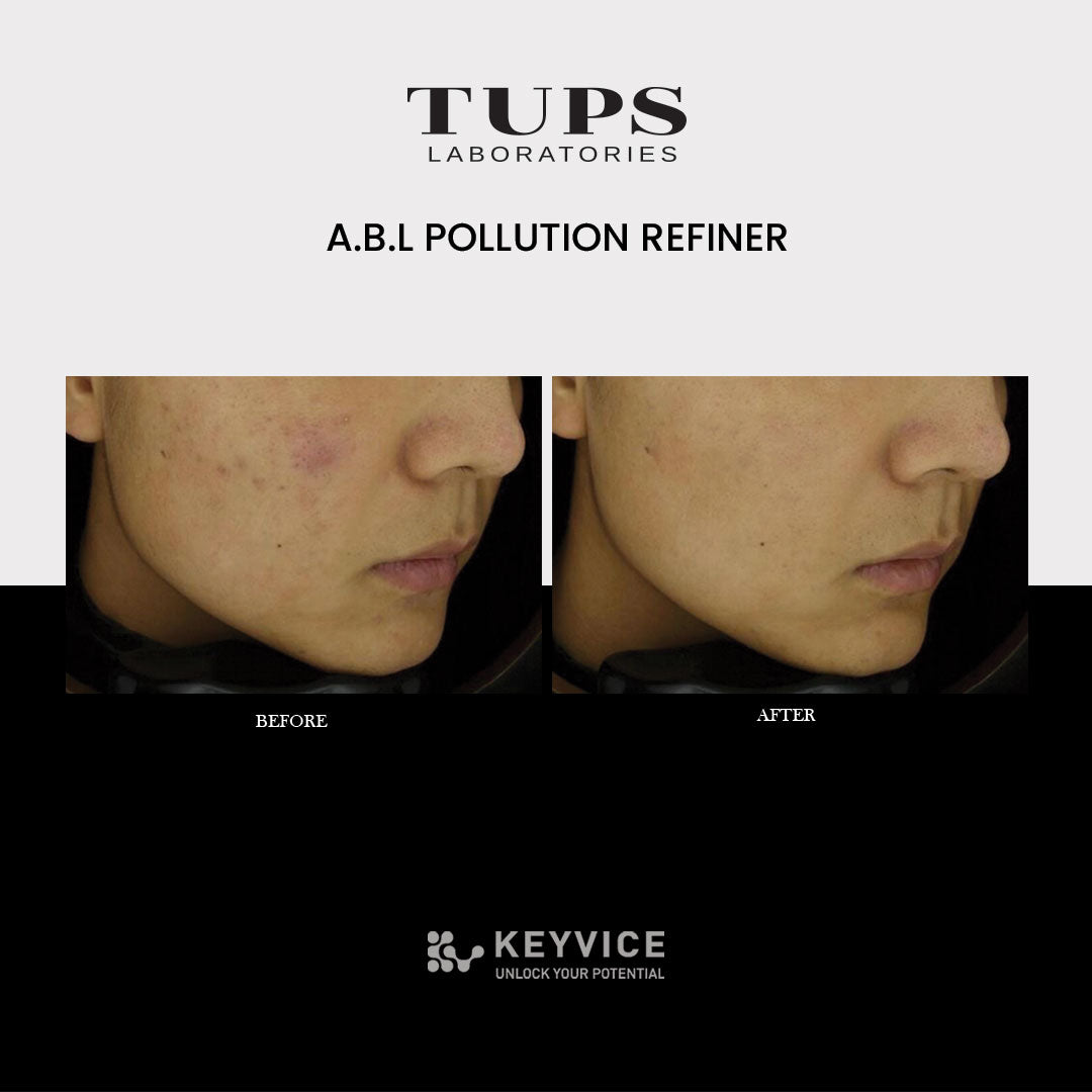 Before and after results of using TUPS A.B.L Pollution Refiner, showing reduced redness, clearer complexion, and smoother skin texture on the cheek area