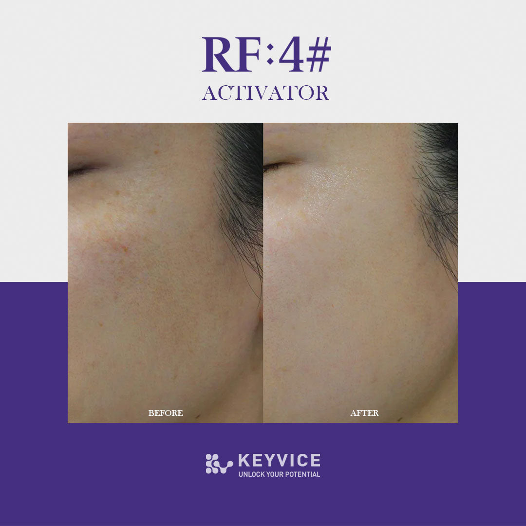 Before-and-after comparison of a cheek using RF:4# Activator treatment, showing improved skin brightness, smoother texture, and reduced pigmentation; branded with Keyvice logo and tagline āUnlock Your Potential