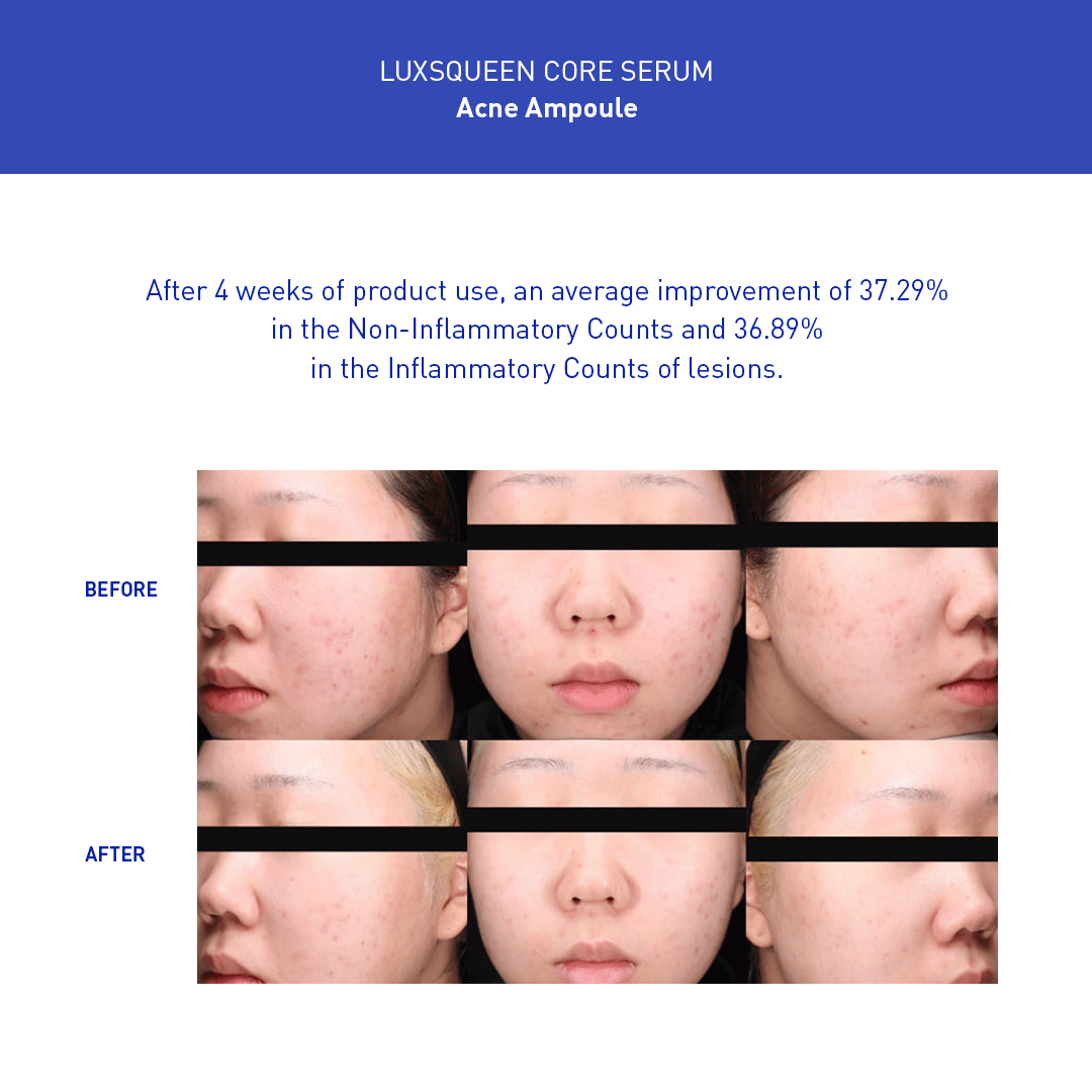Luxsqueen Acne Ampoule before-and-after full-face results after four weeks, with 37.29% improvement in non-inflammatory acne lesions and 36.89% improvement in inflammatory lesions