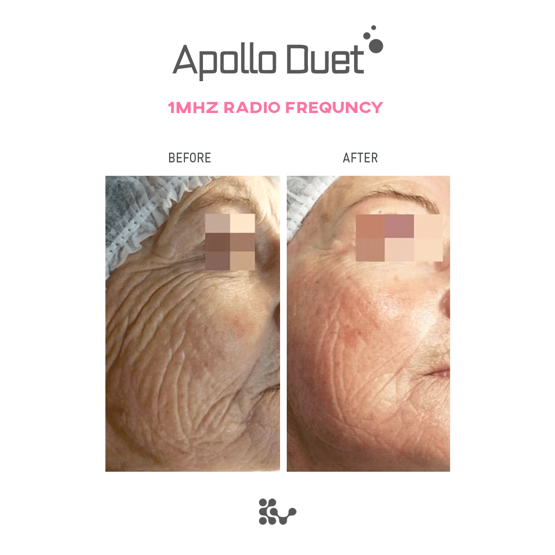 Weero Apollo Duet APD-4000