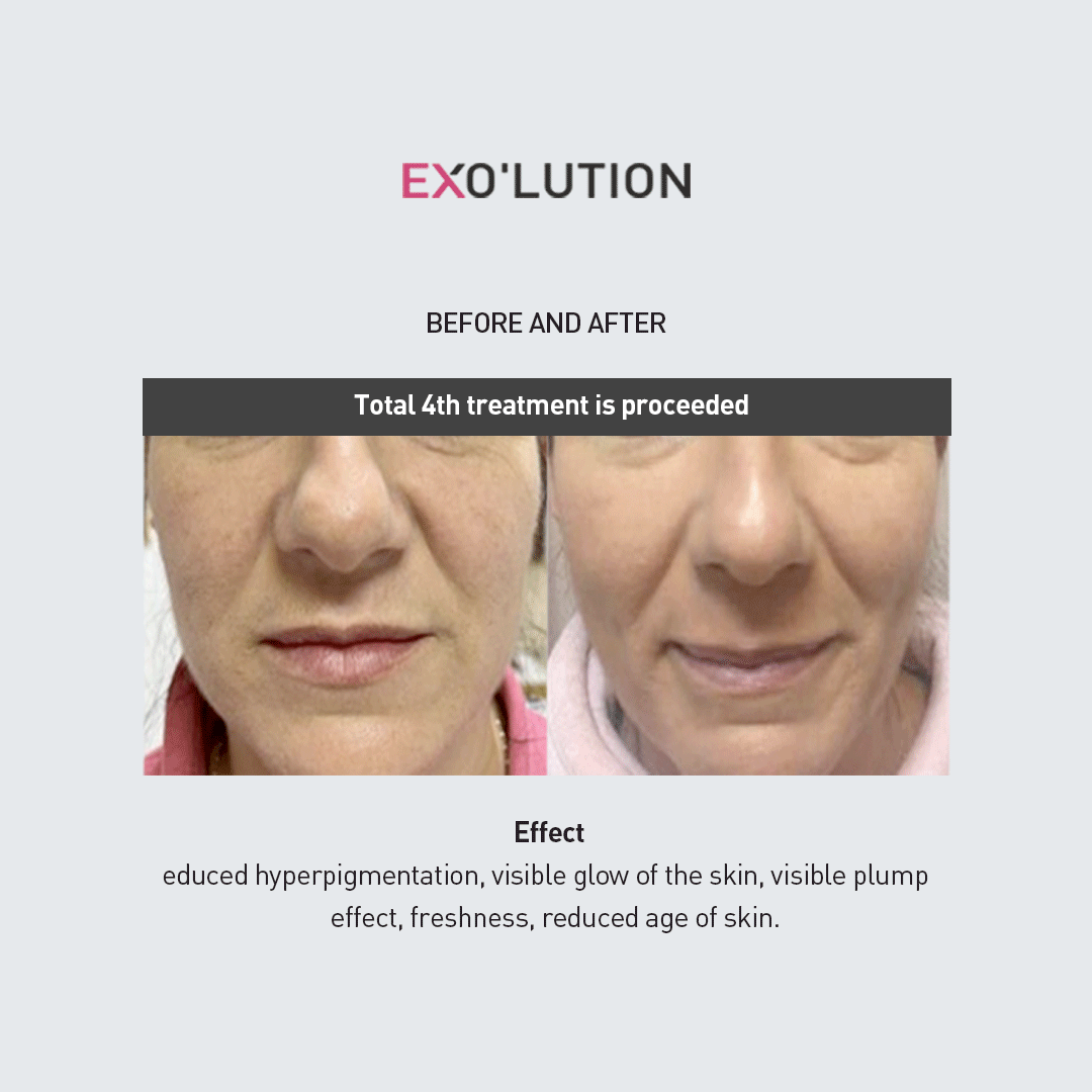 Before-and-after comparison of EXO’LUTION treatment after four sessions, showing improved skin texture, reduced hyperpigmentation and fine-line wrinkles, and a more youthful, glowing complexion on a woman’s face