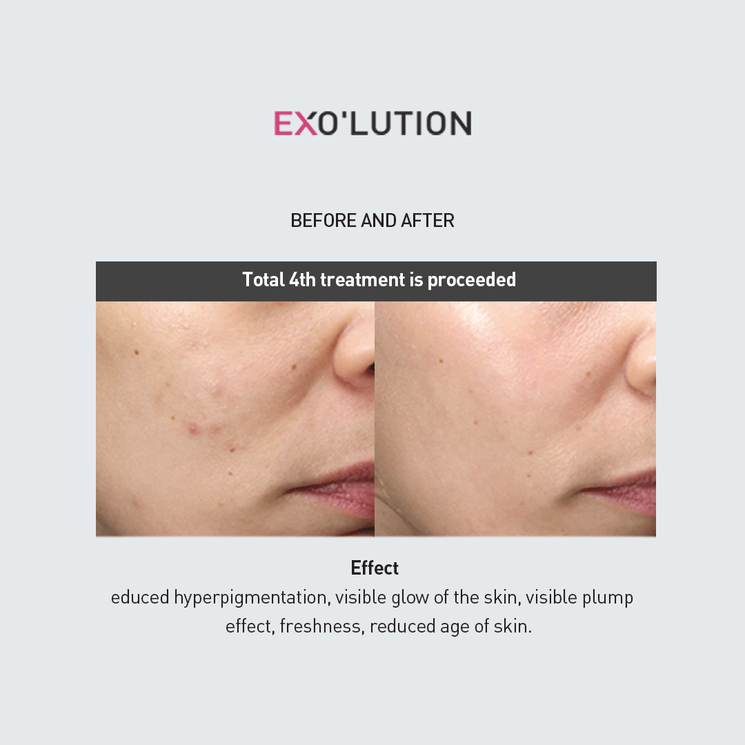 Before-and-after comparison of EXO’LUTION treatment after four sessions, showing reduced redness, and a more youthful, glowing complexion on a woman's cheek