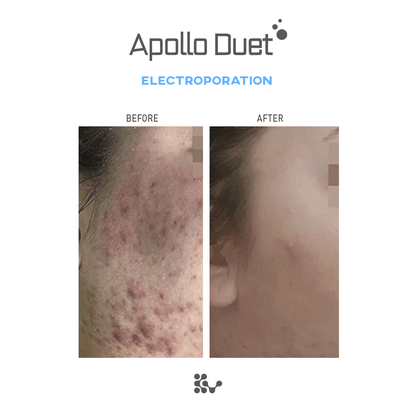 Weero Apollo Duet APD-4000