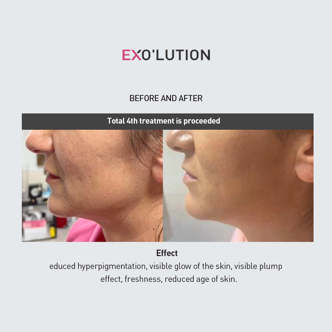 Before-and-after comparison of EXO’LUTION treatment after four sessions, showing improved skin texture, reduced hyperpigmentation, and a more youthful, glowing complexion on a woman’s face