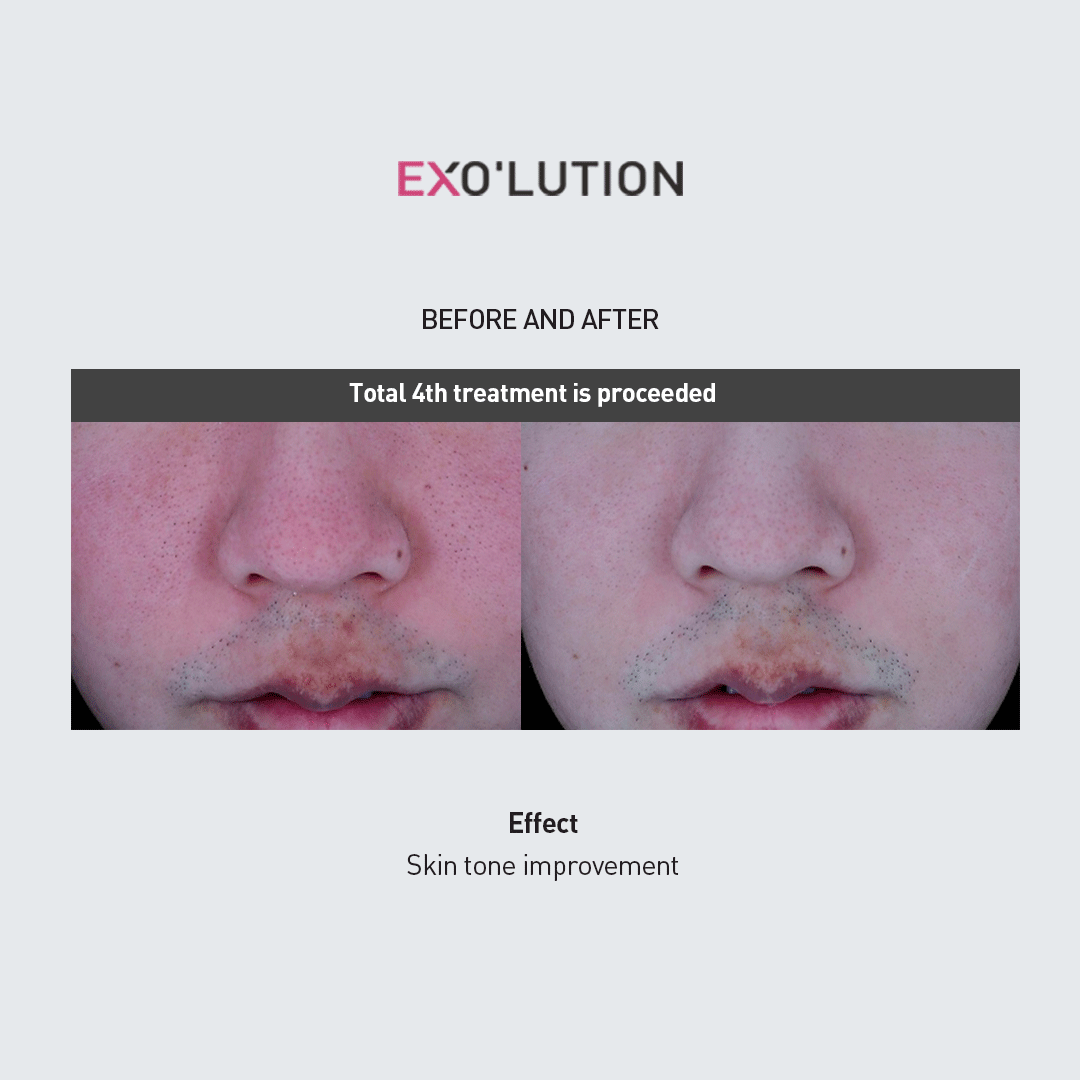 Before-and-after comparison of EXO’LUTION treatment after four sessions, showing improved skin tone and reduced redness around the nose and upper lip area