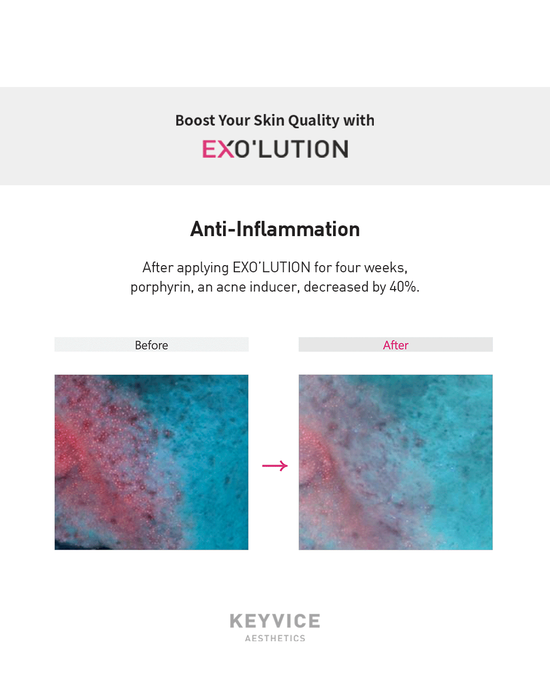 Exo’lution anti-inflammatory results after four weeks, showing 40% reduction in porphyrin, an acne-causing factor, with before-and-after comparison