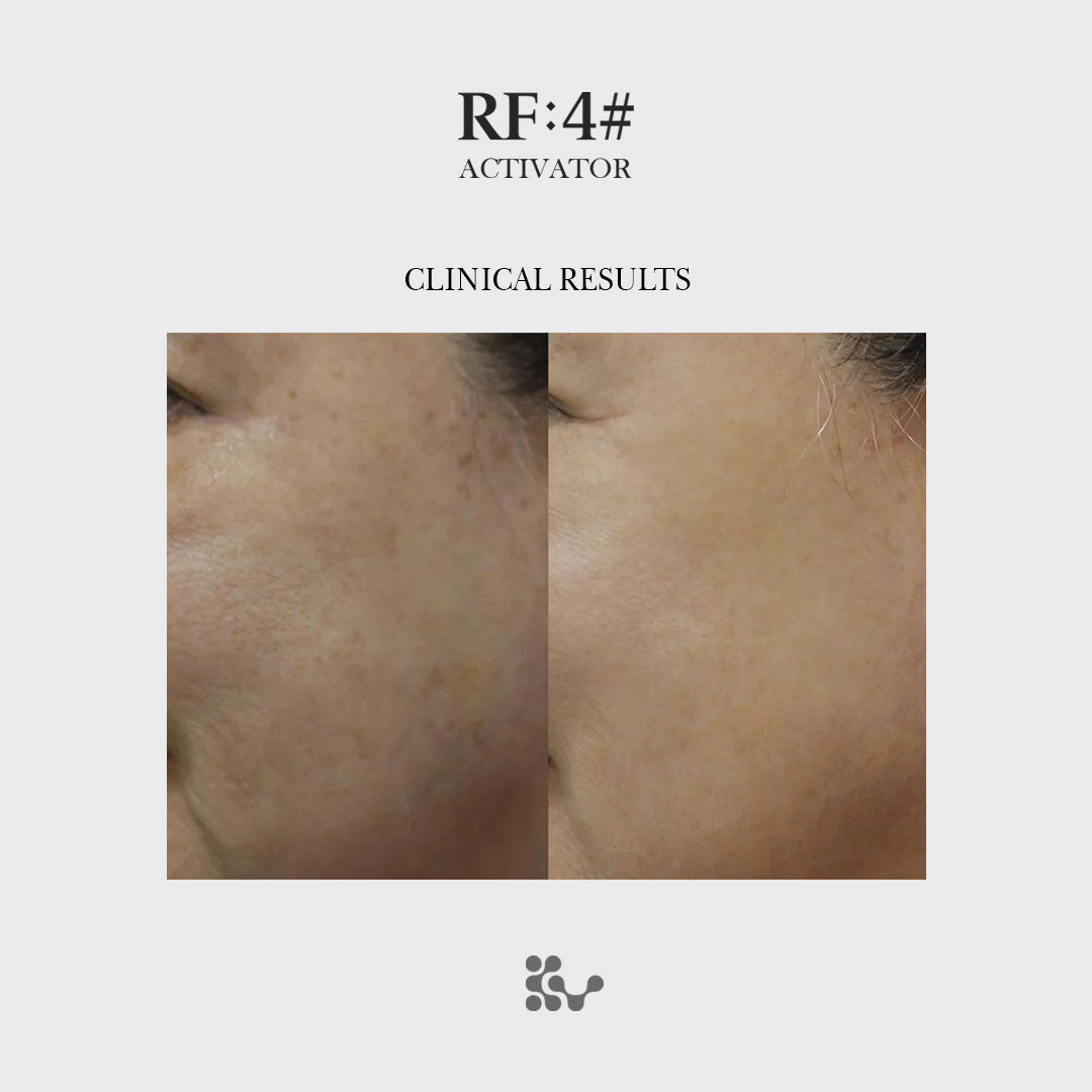 RF:4# Skin Booster Starter Package | Professional RF Treatment Kit