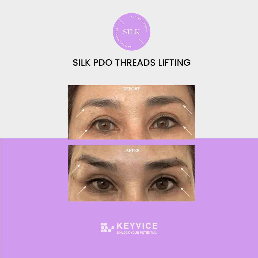 SILK PDO THREAD- Eye reju thread before and after