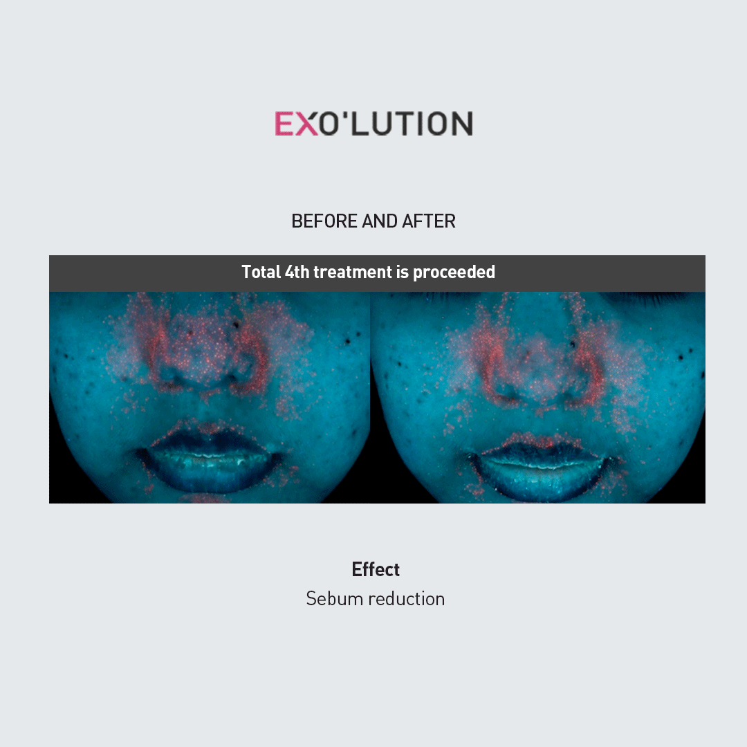 Before-and-after comparison of EXO’LUTION treatment after four sessions, using skin analysis imaging to show reduced sebum levels on the face