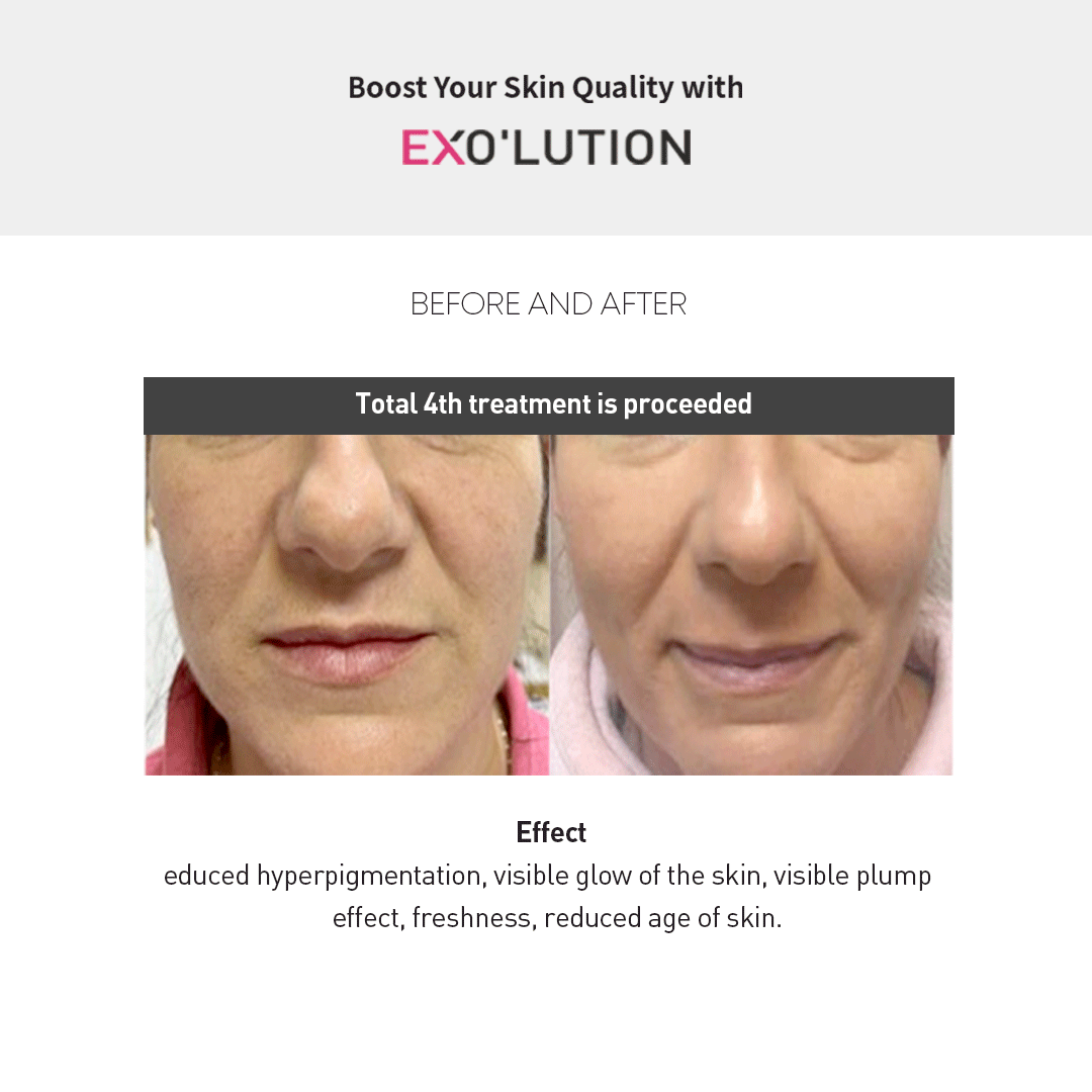 Exo’lution before-and-after results after four treatments, showing reduced hyperpigmentation, enhanced skin glow, plumper texture, refreshed appearance, and younger-looking skin