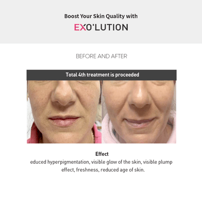 Exo’lution before-and-after results after four treatments, showing reduced hyperpigmentation, enhanced skin glow, plumper texture, refreshed appearance, and younger-looking skin