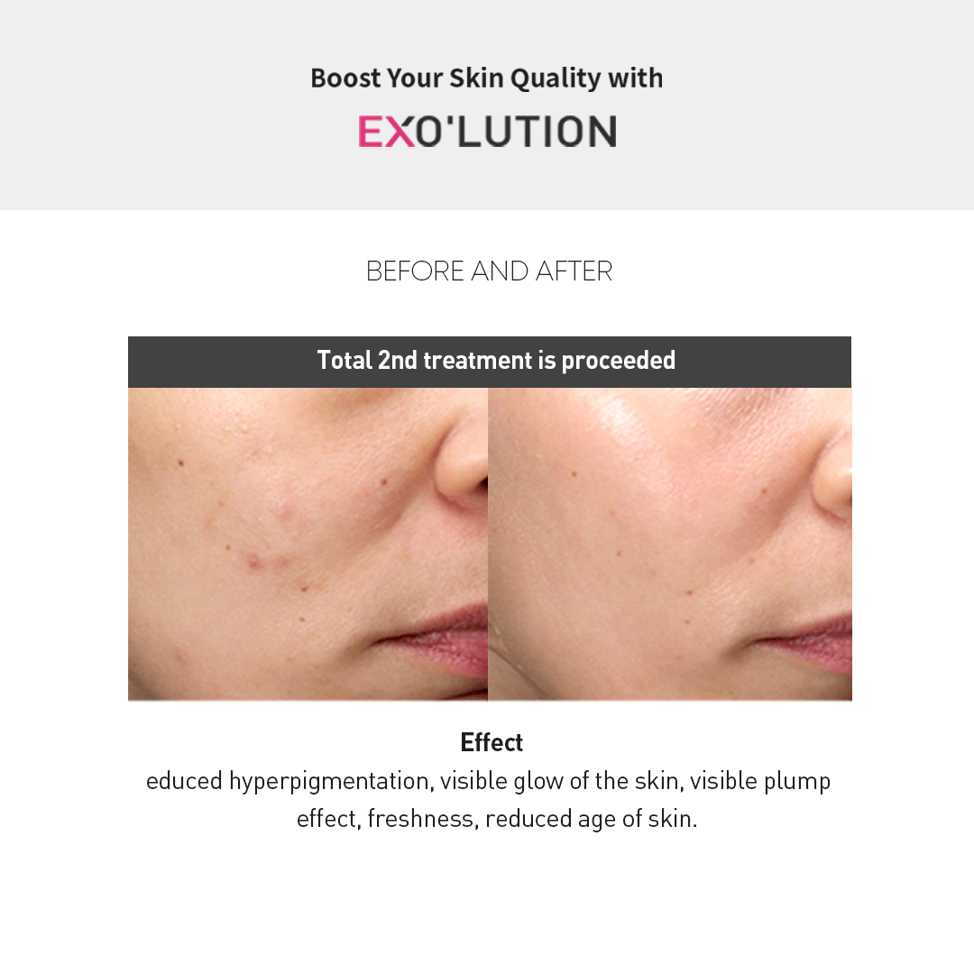 Exo’lution before-and-after results after second treatment, showing reduced hyperpigmentation, enhanced skin glow, plumper texture, refreshed appearance, and younger-looking skin