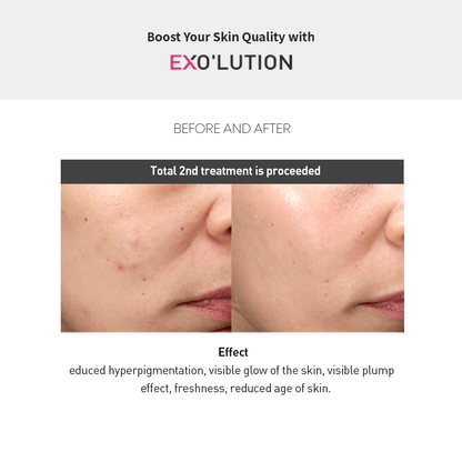 Exo’lution before-and-after results after second treatment, showing reduced hyperpigmentation, enhanced skin glow, plumper texture, refreshed appearance, and younger-looking skin