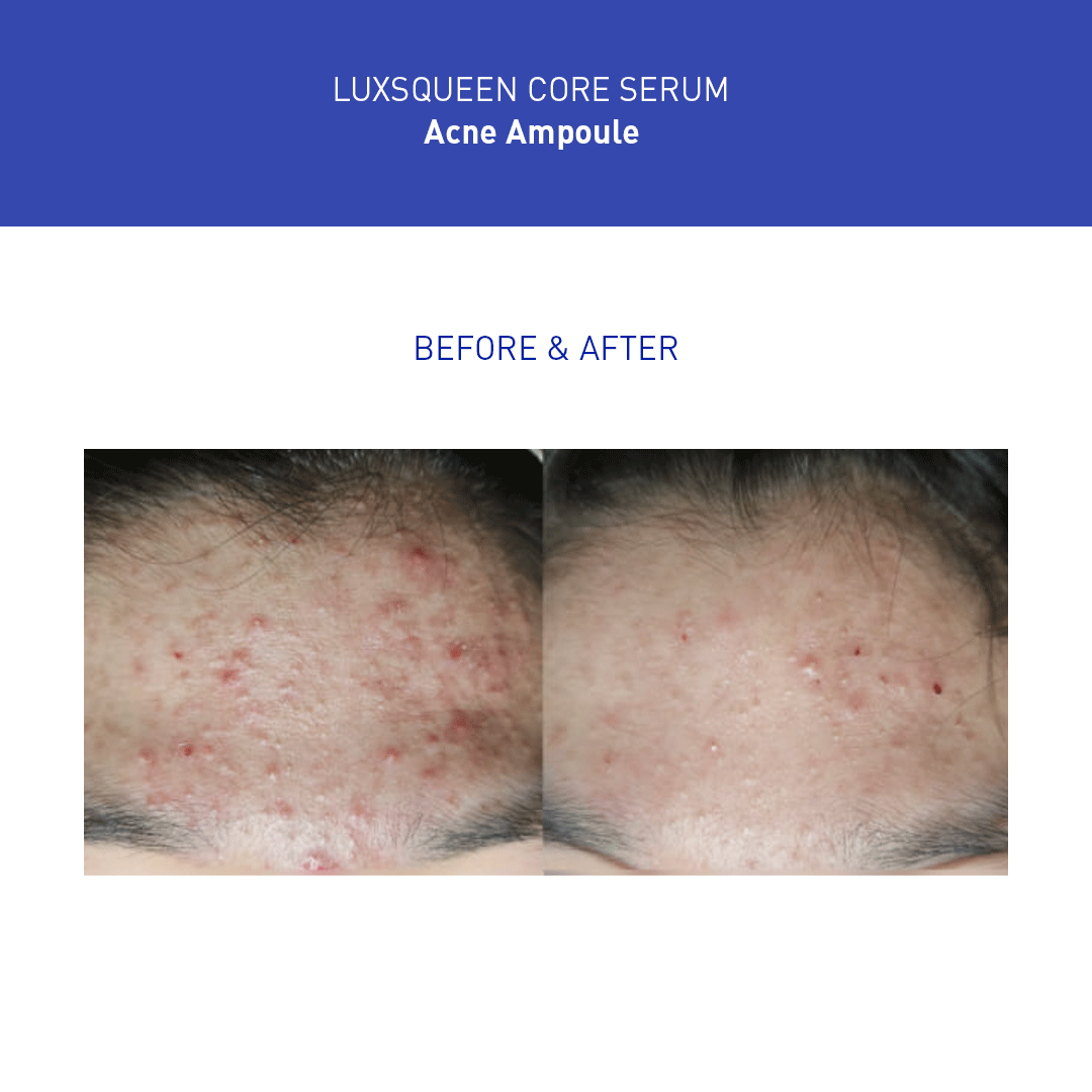 Before-and-after comparison of Luxsqueen Core Serum Acne Ampoule treatment, showing reduced acne on the forehead area