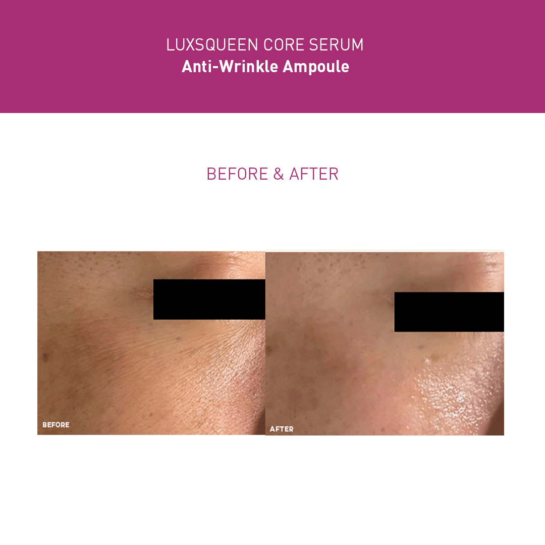 Before-and-after comparison of Luxsqueen Core Serum Anti-Wrinkle Ampoule treatment, showing reduced dark spots and redness around the cheek