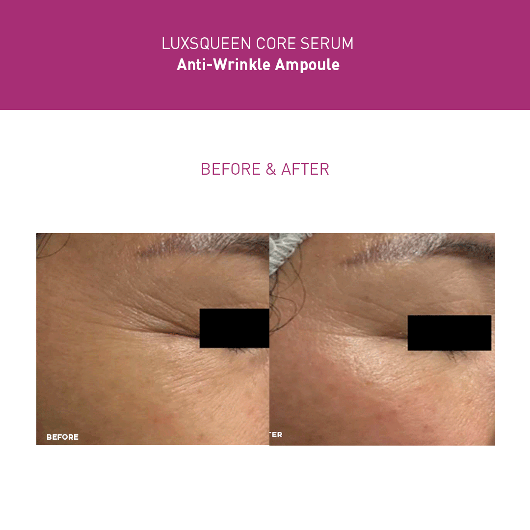 Before-and-after comparison of Luxsqueen Core Serum Anti-Wrinkle Ampoule treatment, showing reduced fine lines and smoother skin around the eye area