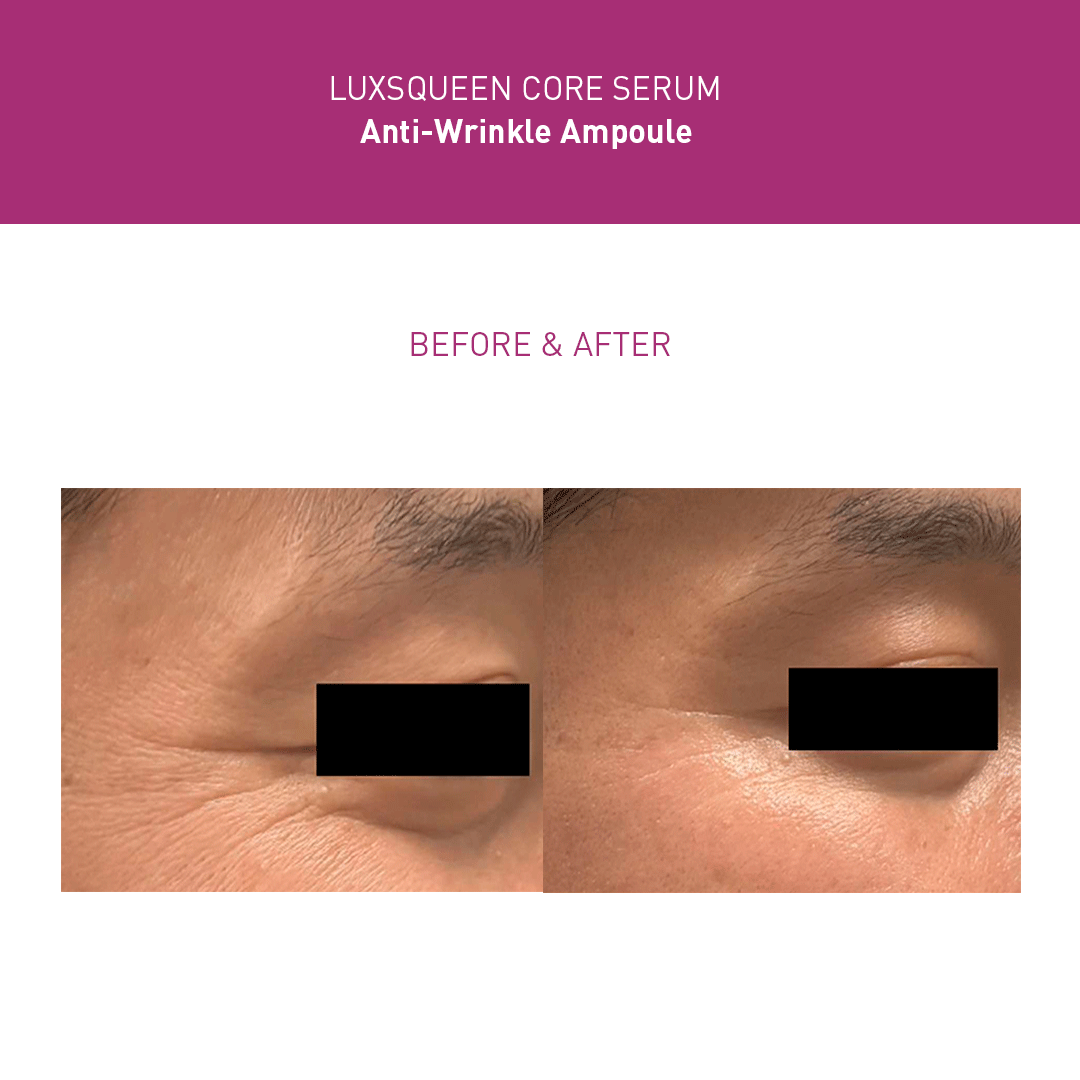 Before-and-after comparison of Luxsqueen Core Serum Anti-Wrinkle Ampoule treatment, showing reduced fine lines and rejuvenated skin around the eye area