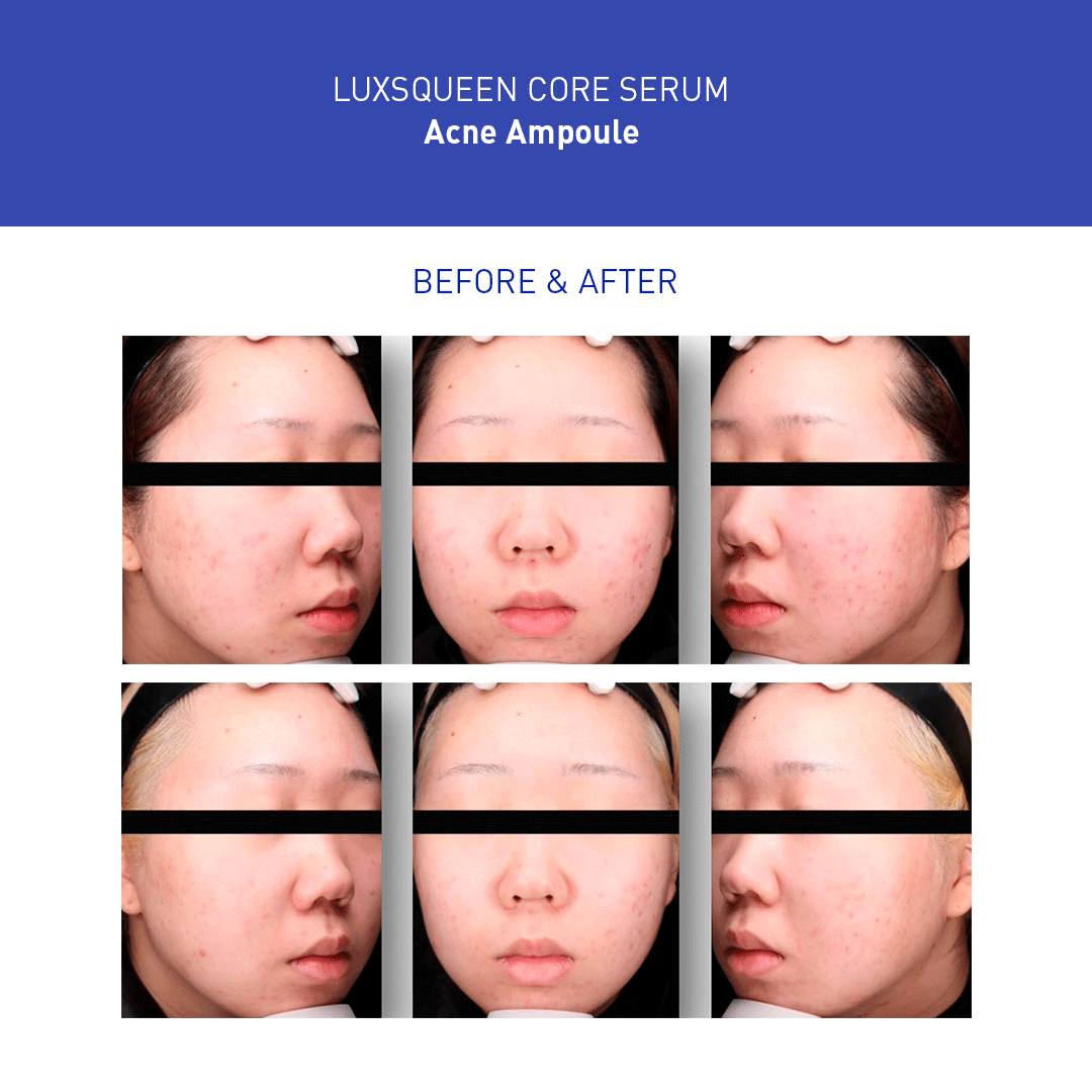 Before-and-after comparison of Luxsqueen Core Serum Acne Ampoule treatment, showing improvement in acne and skin clarity on a woman’s face from multiple angles